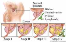 Obat Tradisional Penyakit Kanker Prostat